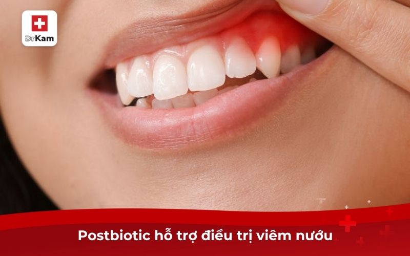 Postbiotic hỗ trợ điều trị Viêm Nướu