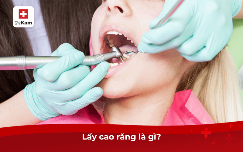 Vì sao nên chăm sóc răng miệng sau khi lấy cao răng? 6 Lấy cao răng là gì?