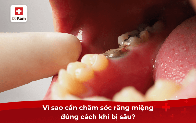 Hướng dẫn các bước chăm sóc răng miệng khi bị sâu răng 7 Vì sao cần chăm sóc răng miệng đúng cách khi bị sâu răng?