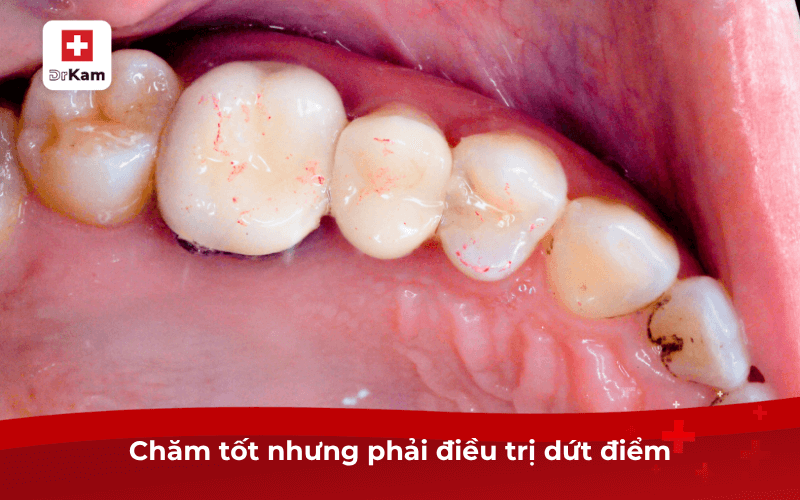 Hướng dẫn các bước chăm sóc răng miệng khi bị sâu răng 10 Chăm tốt nhưng phải điều trị dứt điểm