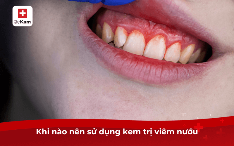 Khi nào nên sử dụng kem trị viêm nướu