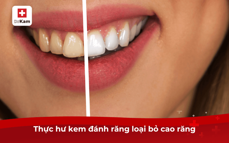 Thực hư kem đánh răng loại bỏ cao răng