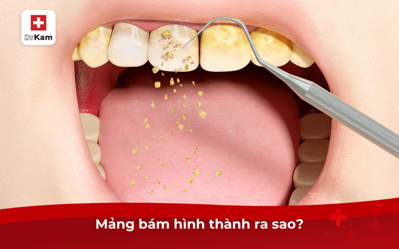 Mảng bám hình thành ra sao?
