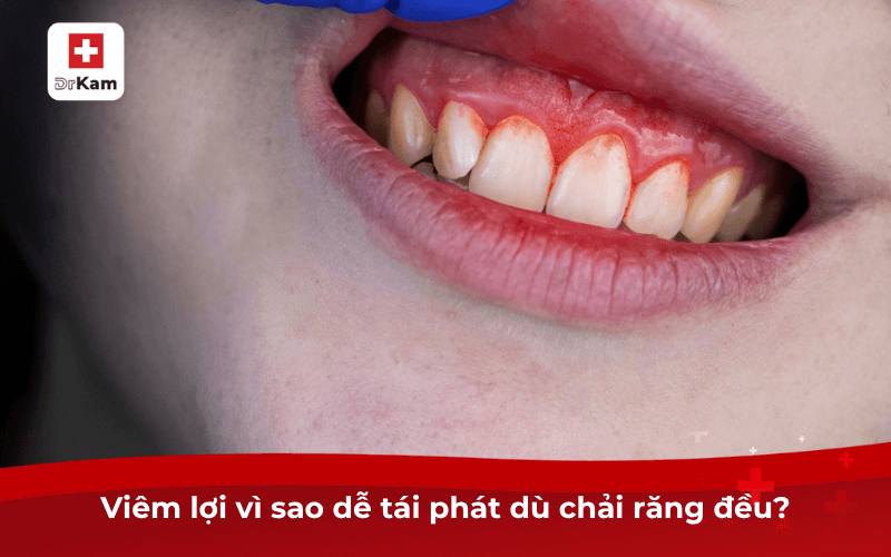 Kem đánh răng vi sinh có phù hợp với người bị viêm lợi không? Tại sao 6 Viêm lợi vì sao dễ tái phát dù chải răng đều?