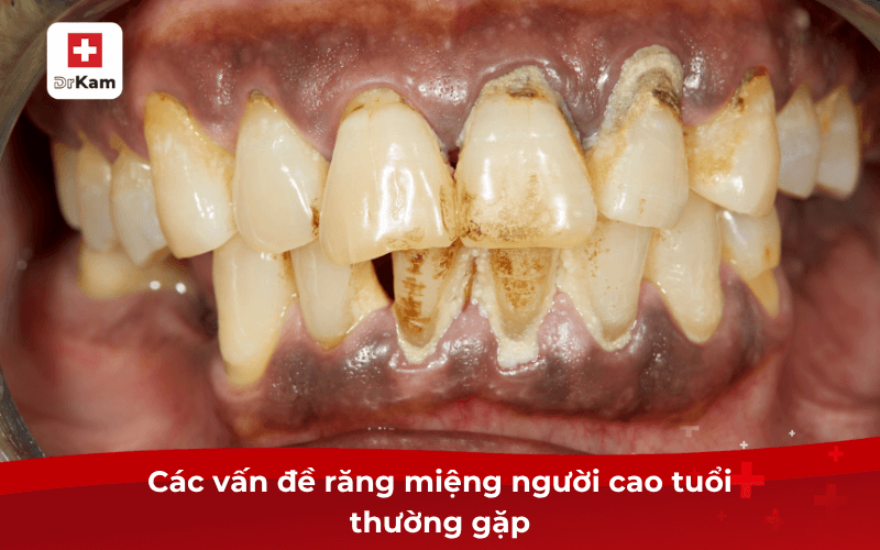 Hướng dẫn các bước chăm sóc răng miệng cho người cao tuổi 7 Các vấn đề răng miệng người cao tuổi thường gặp