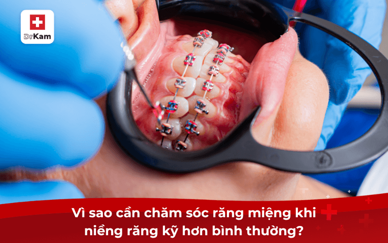 Các bước chăm sóc răng miệng khi niềng răng như thế nào? 6 Vì sao cần chăm sóc răng miệng khi niềng răng kỹ hơn bình thường?