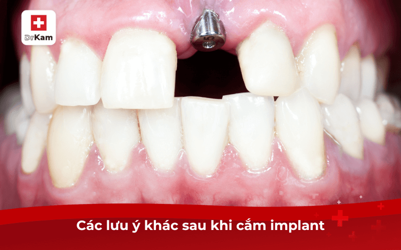 Nước súc miệng sau khi cắm implant được bác sĩ khuyên dùng? Cách chọn và lưu ý 7 Các lưu ý khác sau khi cắm implant