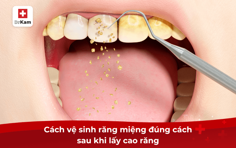 Cách vệ sinh răng miệng đúng cách sau khi lấy cao răng