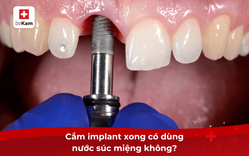Nước súc miệng sau khi cắm implant được bác sĩ khuyên dùng? Cách chọn và lưu ý 5 Cắm implant xong có dùng nước súc miệng không?