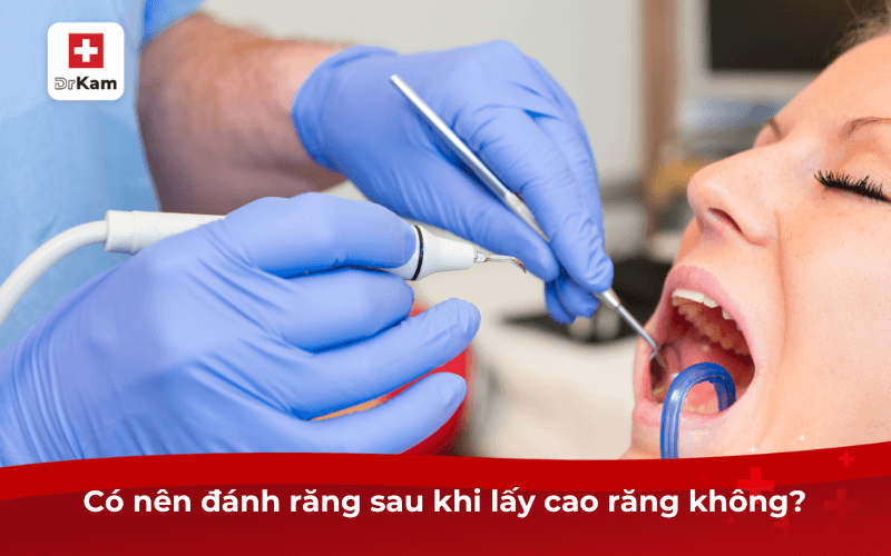 Sau khi lấy cao răng có được đánh răng không?