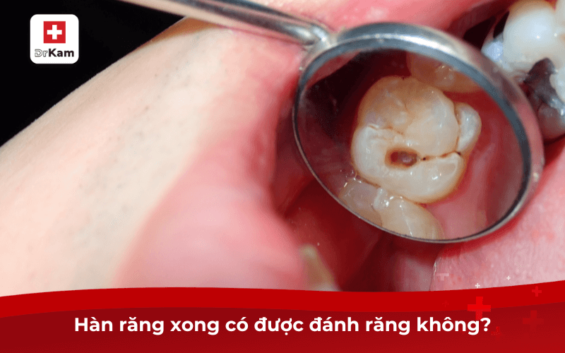 Hàn răng xong có được đánh răng không?