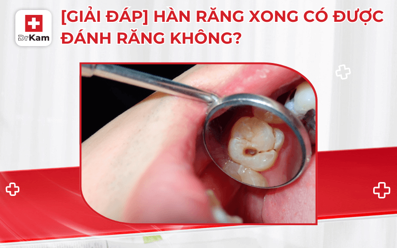 han rang xong co duoc danh rang khong