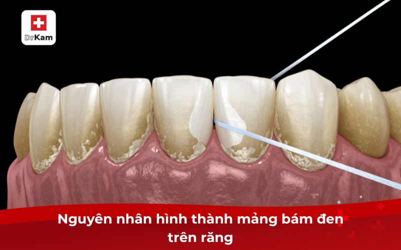 Mảng bám đen trên răng - 7 cách làm sạch hiệu quả ngay lập tức 6 Nguyên nhân hình thành mảng bám đen trên răng