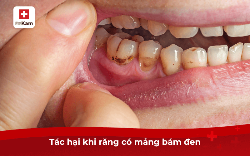 Mảng bám đen trên răng - 7 cách làm sạch hiệu quả ngay lập tức 7 Tác hại khi răng có mảng bám đen