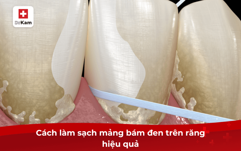 Mảng bám đen trên răng - 7 cách làm sạch hiệu quả ngay lập tức 8 Cách làm sạch mảng bám đen trên răng hiệu quả