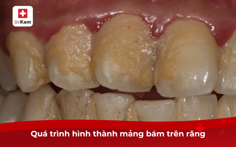Mảng bám răng có hại không? Quá trình hình thành, nguyên nhân và cách loại bỏ hiệu quả 6 Quá trình hình thành mảng bám răng