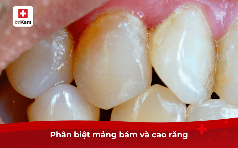 Mảng bám răng có hại không? Quá trình hình thành, nguyên nhân và cách loại bỏ hiệu quả 8 Phân biệt mảng bám và cao răng
