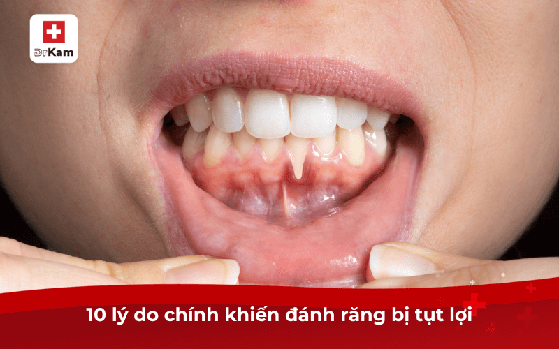 10 lý do chính khiến đánh răng bị tụt lợi