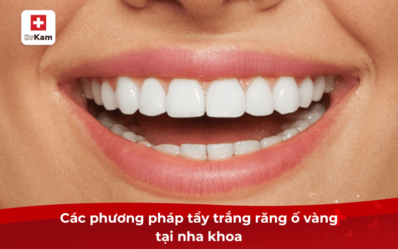 20 Cách tẩy trắng răng ố vàng an toàn hiệu quả nhất hiện nay 6 Các phương pháp tẩy trắng răng ố vàng tại nha khoa