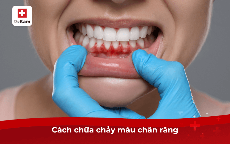 Cách chữa chảy máu chân răng