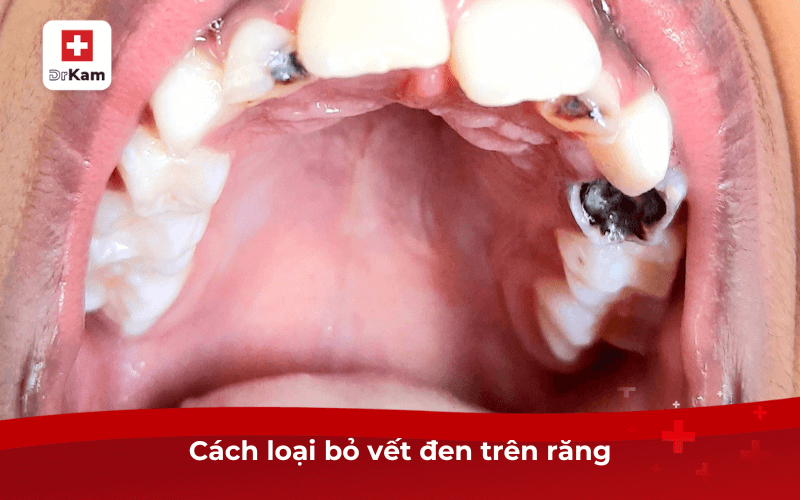 Cách loại bỏ răng có vết đen