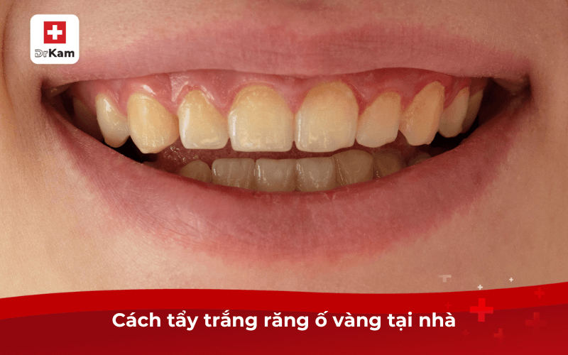 20 Cách tẩy trắng răng ố vàng an toàn hiệu quả nhất hiện nay 5 Cách tẩy trắng răng ố vàng tại nhà