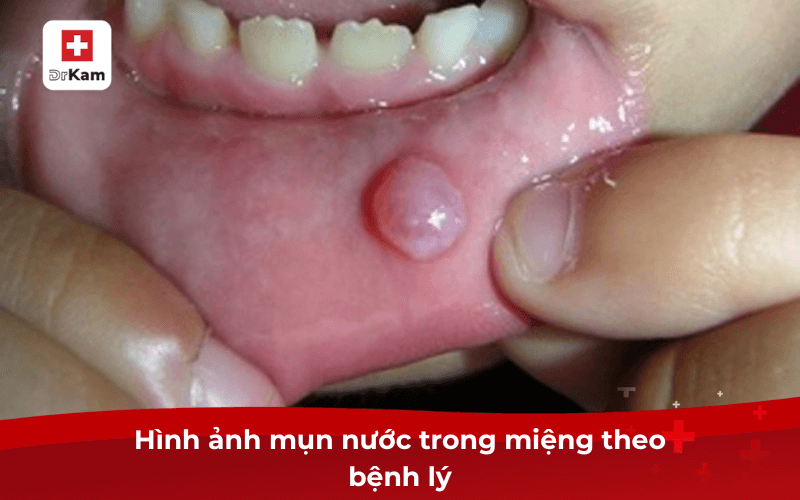 Hình ảnh mụn nước trong miệng theo bệnh lý