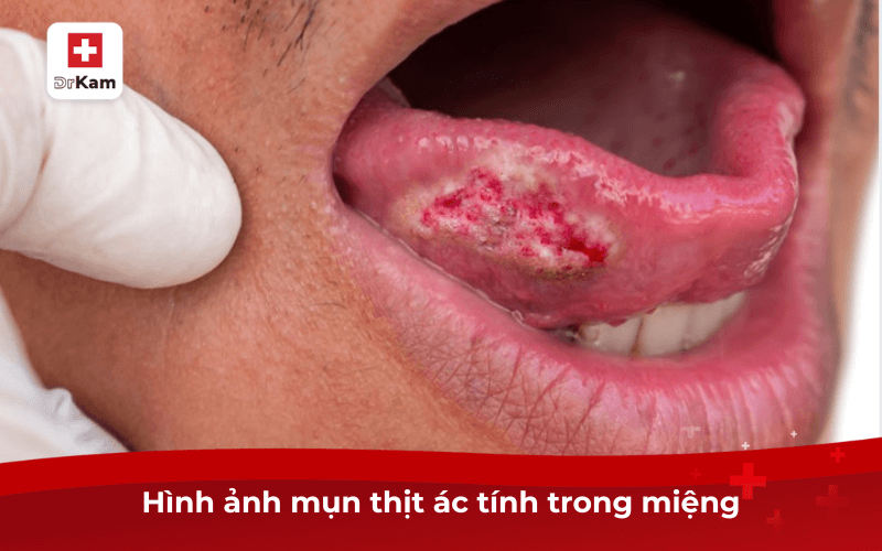 Cận cảnh hình ảnh mụn thịt trong miệng cần biết và điều trị ngay 8 Hình ảnh mụn thịt ác tính trong miệng