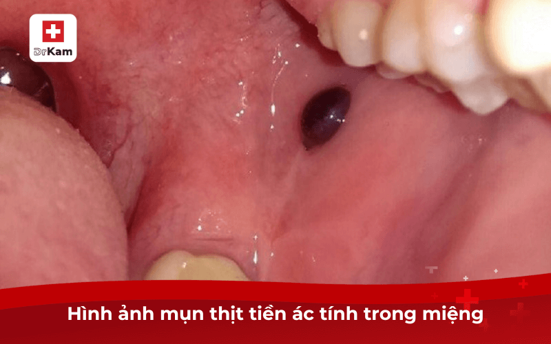 Cận cảnh hình ảnh mụn thịt trong miệng cần biết và điều trị ngay 7 Hình ảnh mụn thịt tiền ác tính trong miệng