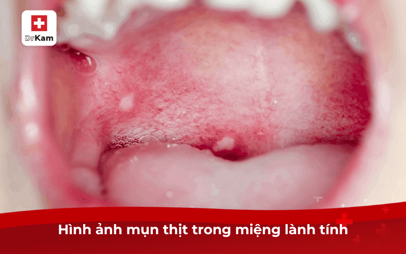 Cận cảnh hình ảnh mụn thịt trong miệng cần biết và điều trị ngay 6 Hình ảnh mụn thịt trong miệng lành tính