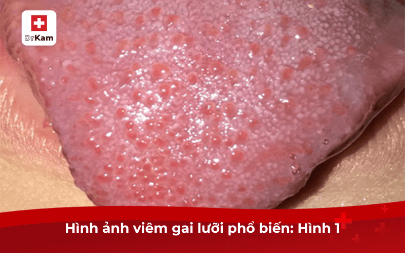 Hình ảnh viêm gai lưỡi phổ biến