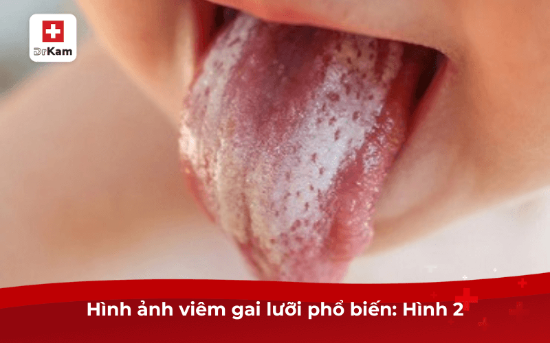 hinh anh viem gai luoi pho bien hinh 2 1