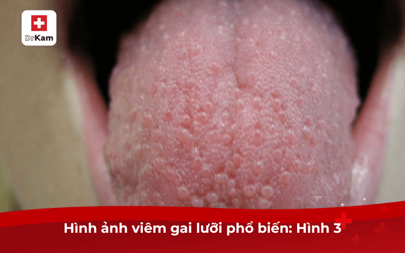 hinh anh viem gai luoi pho bien hinh 3 1