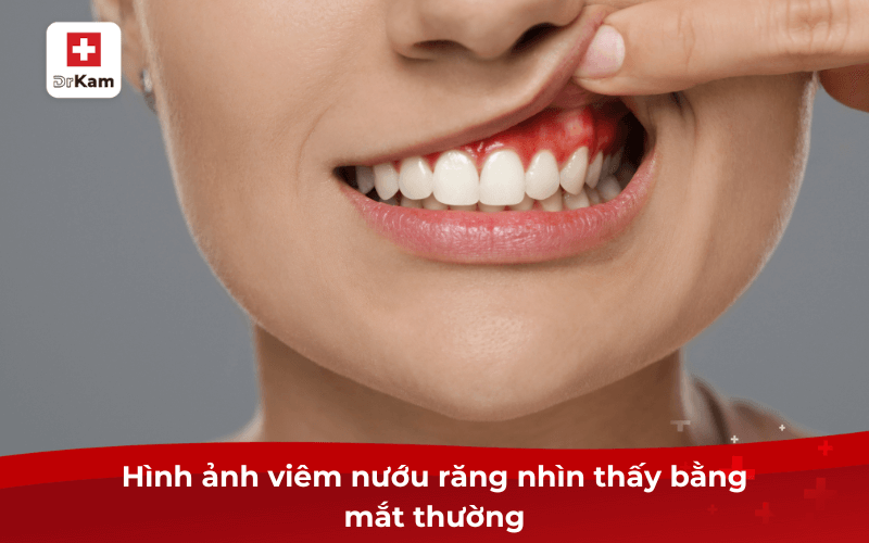 Review thực tế hình ảnh viêm nướu răng cần điều trị ngay tránh biến chứng 4 Hình ảnh viêm nướu răng nhìn thấy bằng mắt thường