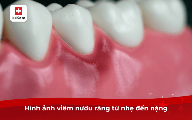Review thực tế hình ảnh viêm nướu răng cần điều trị ngay tránh biến chứng 5 Hình ảnh viêm nướu răng từ nhẹ đến nặng