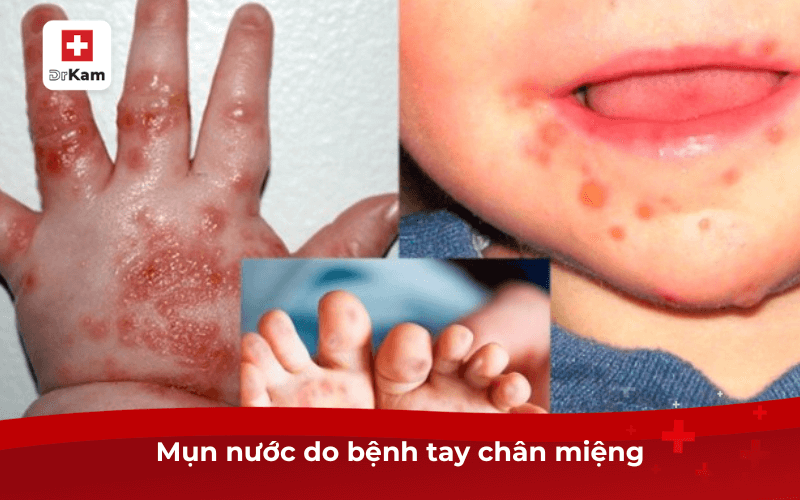 Mụn nước do bệnh tay chân miệng