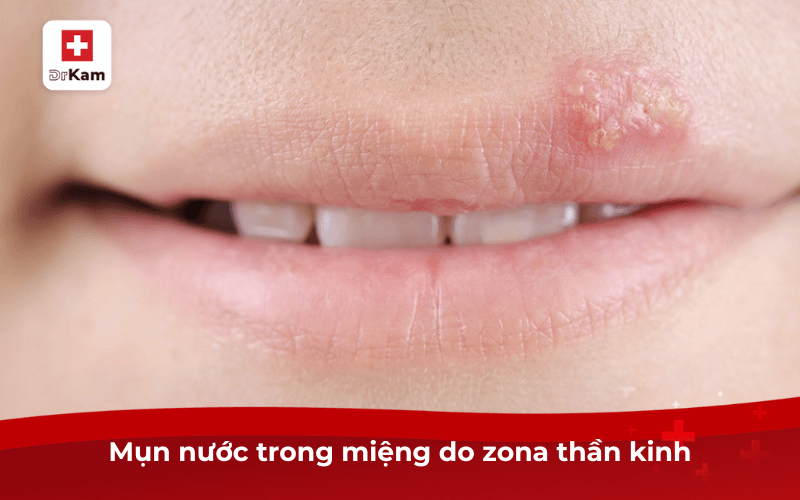 Mụn nước trong miệng do zona thần kinh