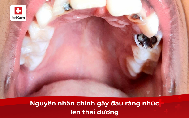 Nguyên nhân chính gây đau răng nhức lên thái dương