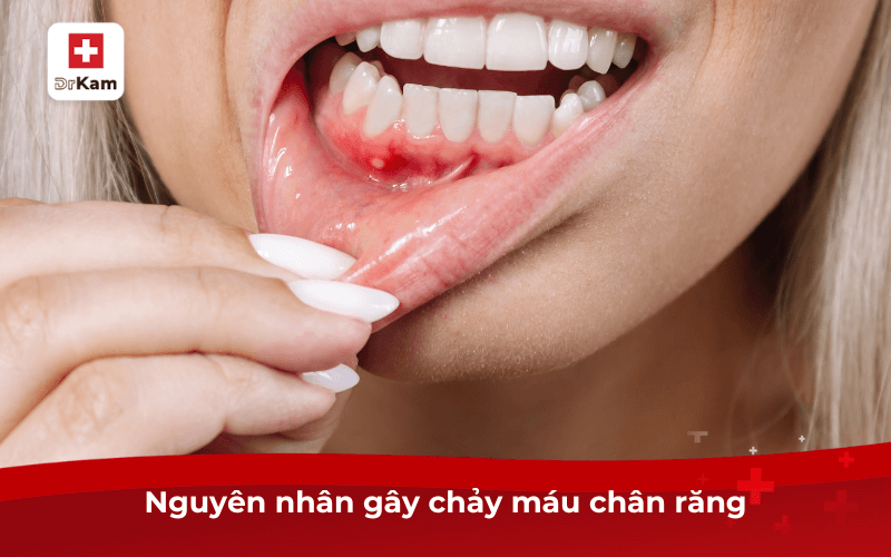 Nguyên nhân gây chảy máu chân răng