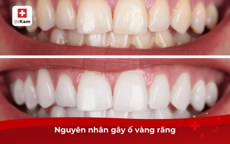 Răng ố vàng: 10 nguyên nhân, tác hại và cách khắc phục hiệu quả 5 Nguyên nhân gây ố vàng răng