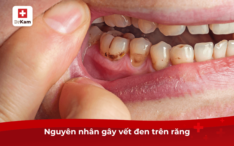 Nguyên nhân gây vết đen trên răng