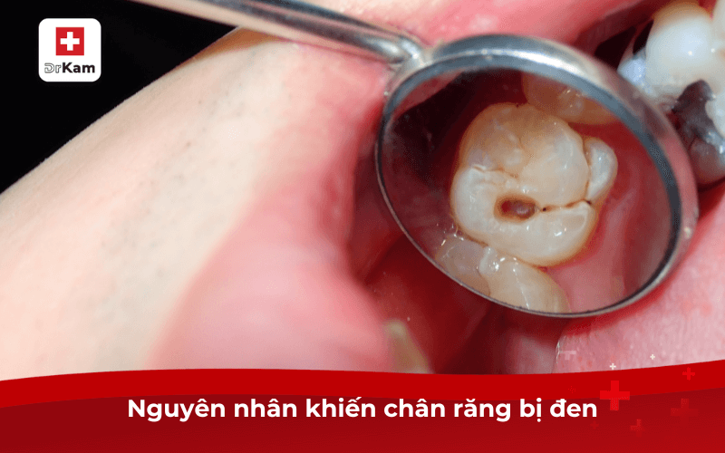 Nguyên nhân khiến chân răng bị đen
