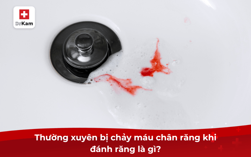 Thường xuyên bị chảy máu chân răng khi đánh răng là gì?