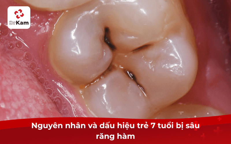 Nguyên nhân và dấu hiệu trẻ 7 tuổi bị sâu răng hàm