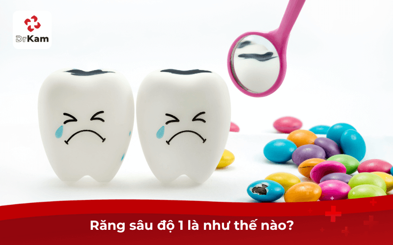 Răng sâu độ 1 là như thế nào?