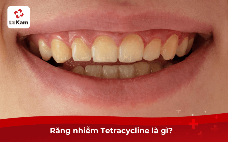 Răng nhiễm Tetracycline là gì?