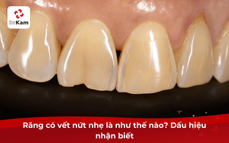 Răng có vết nứt nhẹ là như thế nào? Dấu hiệu nhận biết
