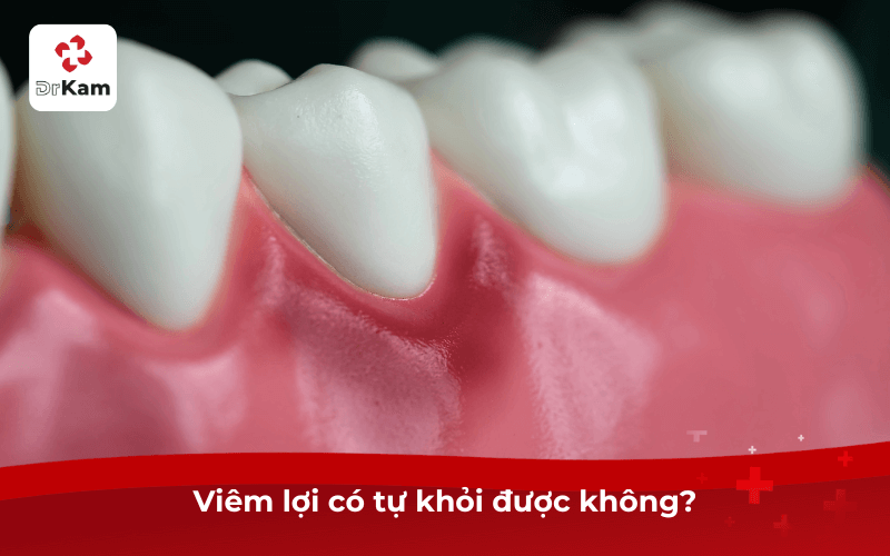 Viêm lợi có tự khỏi được không?