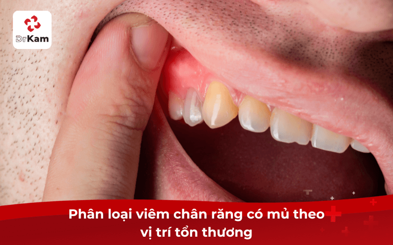 Viêm chân răng có mủ là gì?