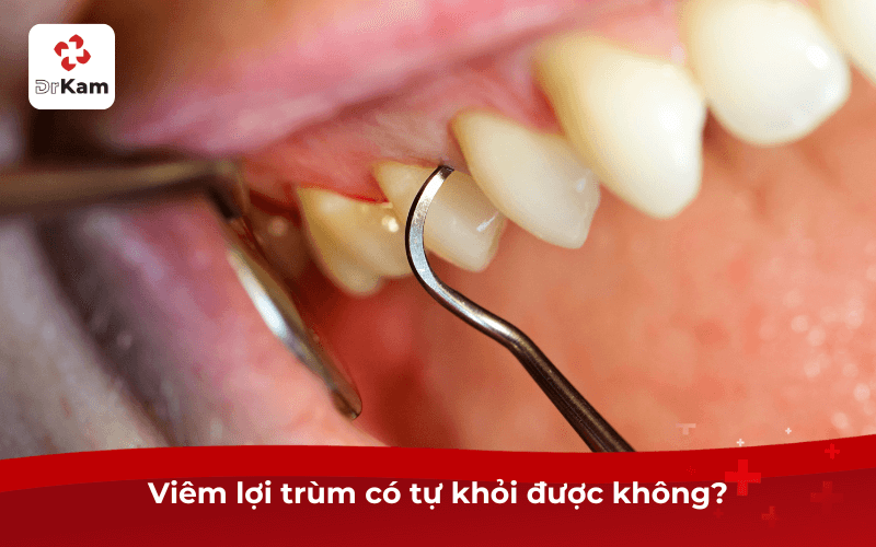 Tôi bị viêm lợi tự khỏi được không? Biện pháp điều trị dứt điểm hiệu quả 4 Viêm lợi trùm có tự khỏi được không?